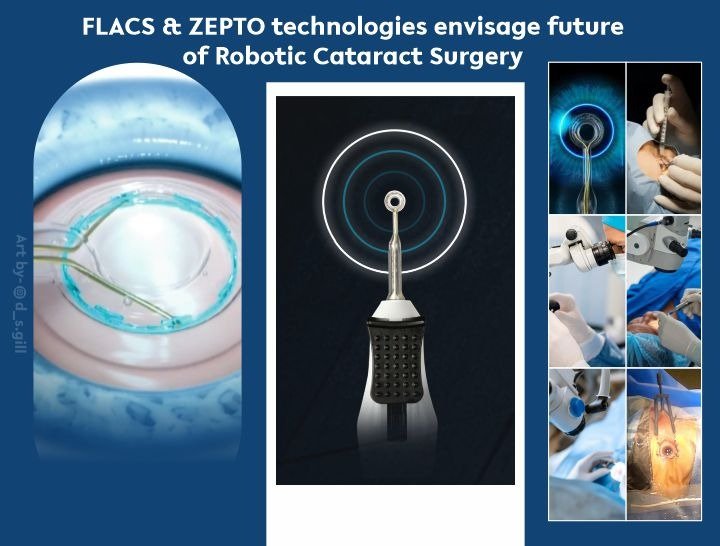 Zepto Cataract Surgery Latest Advancement In Cataract Surgery Best