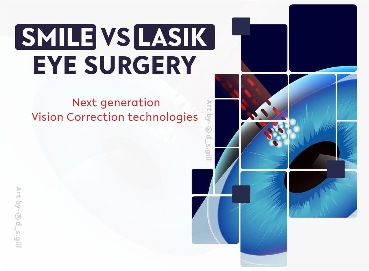 Smile vs Lasik eye surgery