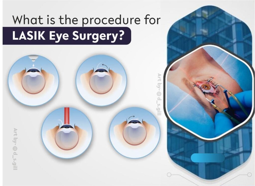 What is the procedure for LASIK Eye Surgery?