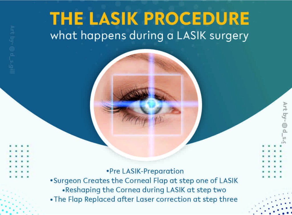 The LASIK Procedure what happens during a LASIK surgery