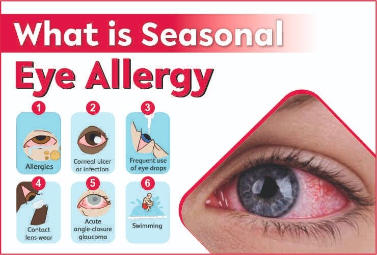 seasonal eye allergy