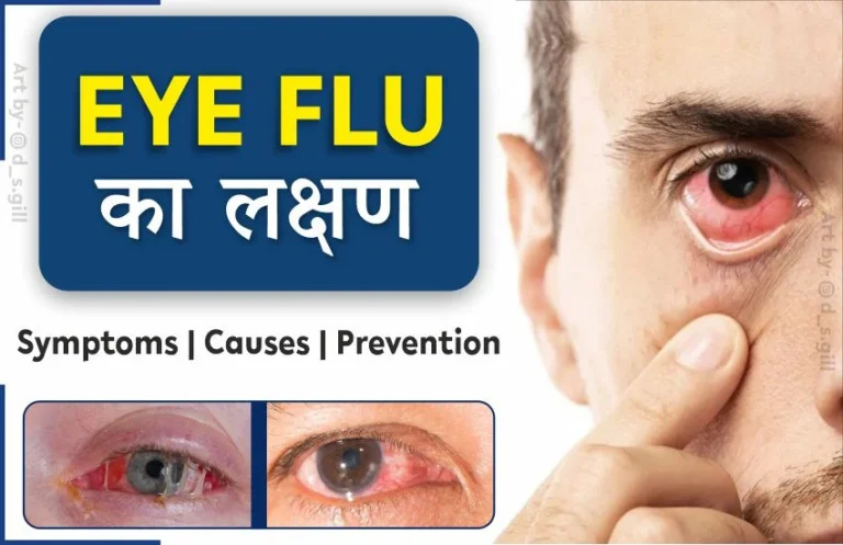 Eye flu ke lakshan