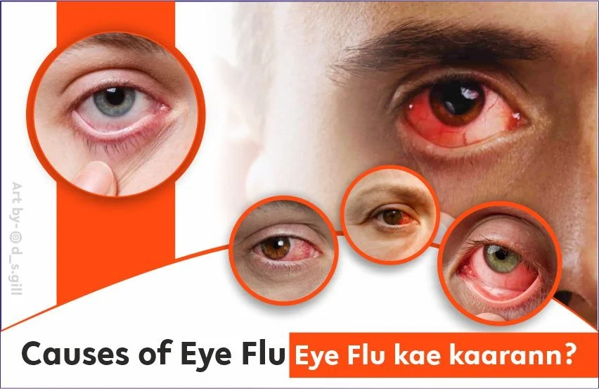 causes of eye flu